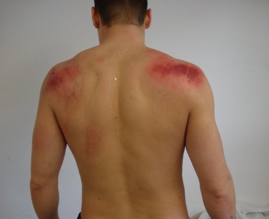 Shirtless guy with long red marks on upper back