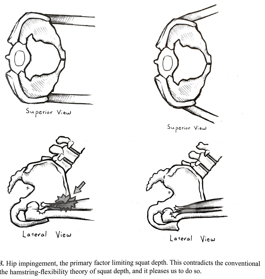 Four line drawings of hip joint with caption: Hip impingement, the primary factor limiting squat depth. This contradicts the conventional hamstring-flexibility theory of squat depth, and it pleases us to do so